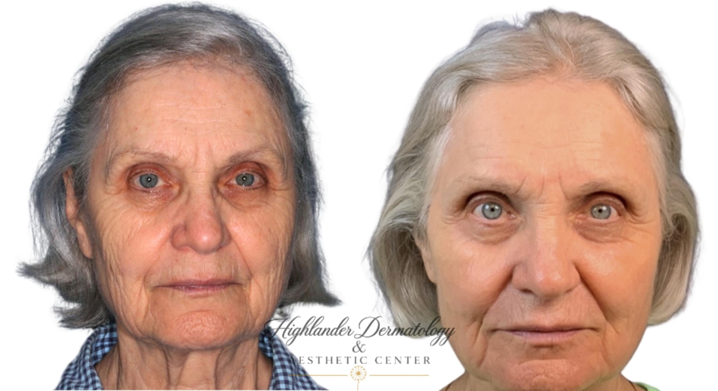 Before & After CO2 Laser Resurfacing Case 19 Front View in Brookfield, Franklin, Wisonsin
