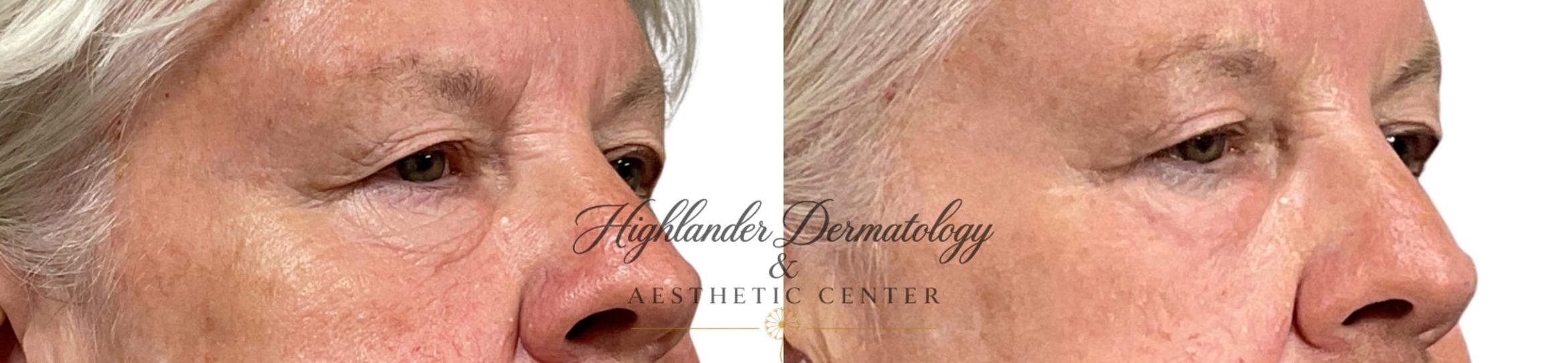 Before & After CO2 Laser Resurfacing Case 24 Right Oblique View in Brookfield, Franklin, Wisonsin