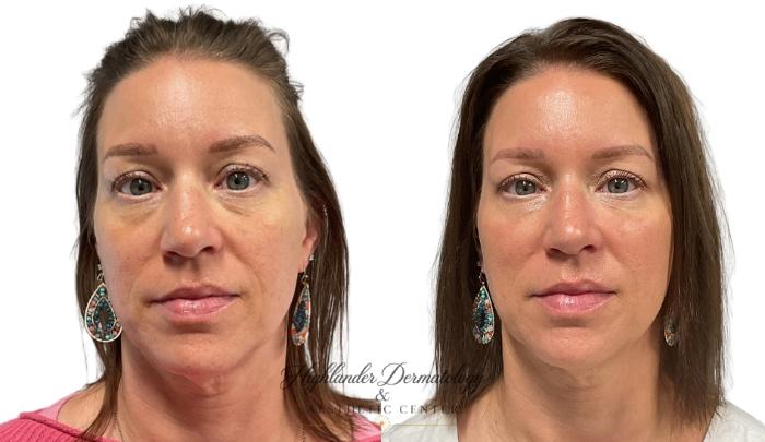 Before & After Dermal Fillers Case 18 Front View in Brookfield, Franklin, Wisonsin
