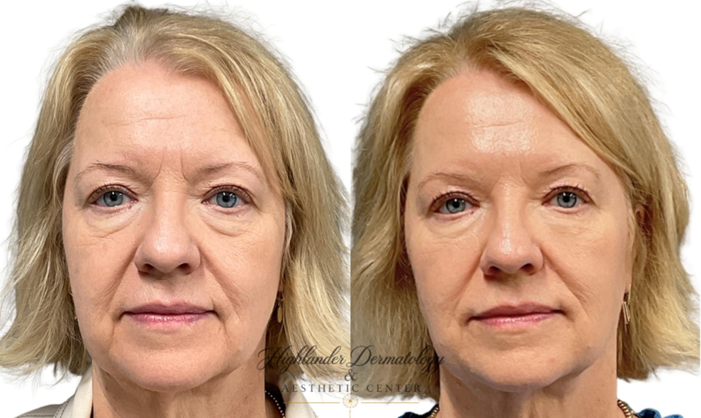 Before & After Dermal Fillers Case 20 Front View in Brookfield, Franklin, Wisonsin