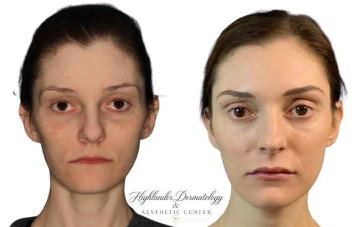 Before & After Dermal Fillers Case 22 Front View in Brookfield, Franklin, Wisonsin