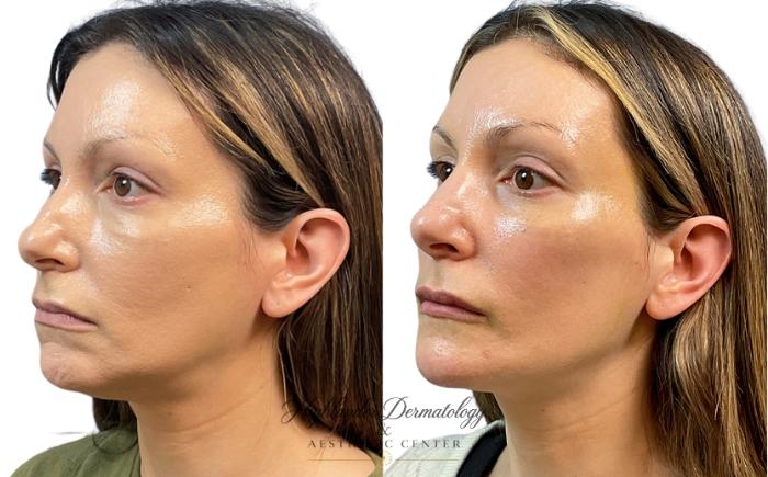 Before & After Dermal Fillers Case 23 Left Oblique View in Brookfield, Franklin, Wisonsin