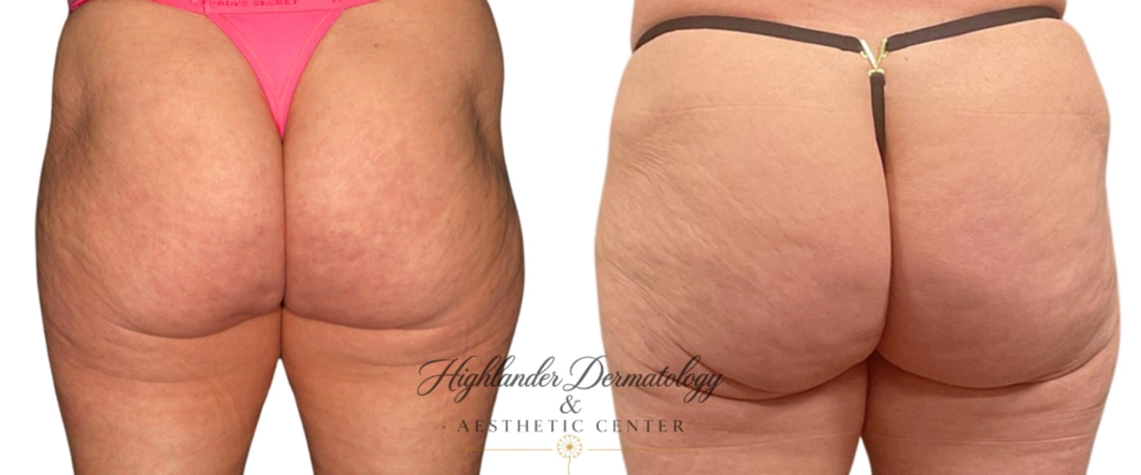 Before & After Dermal Fillers Case 25 Back View in Brookfield, Franklin, Wisonsin