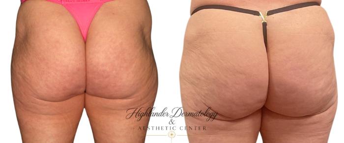 Before & After Dermal Fillers Case 25 Back View in Brookfield, Franklin, Wisonsin