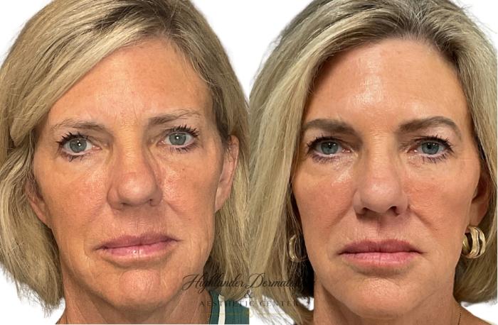 Before & After Dermal Fillers Case 26 Front View in Brookfield, Franklin, Wisonsin