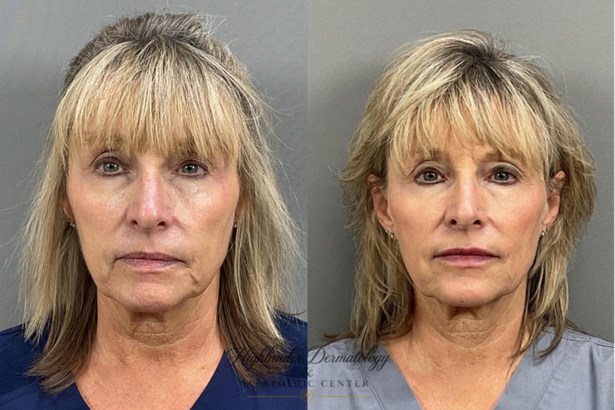 Before & After Dermal Fillers Case 7 Front View in Brookfield, Franklin, Wisonsin