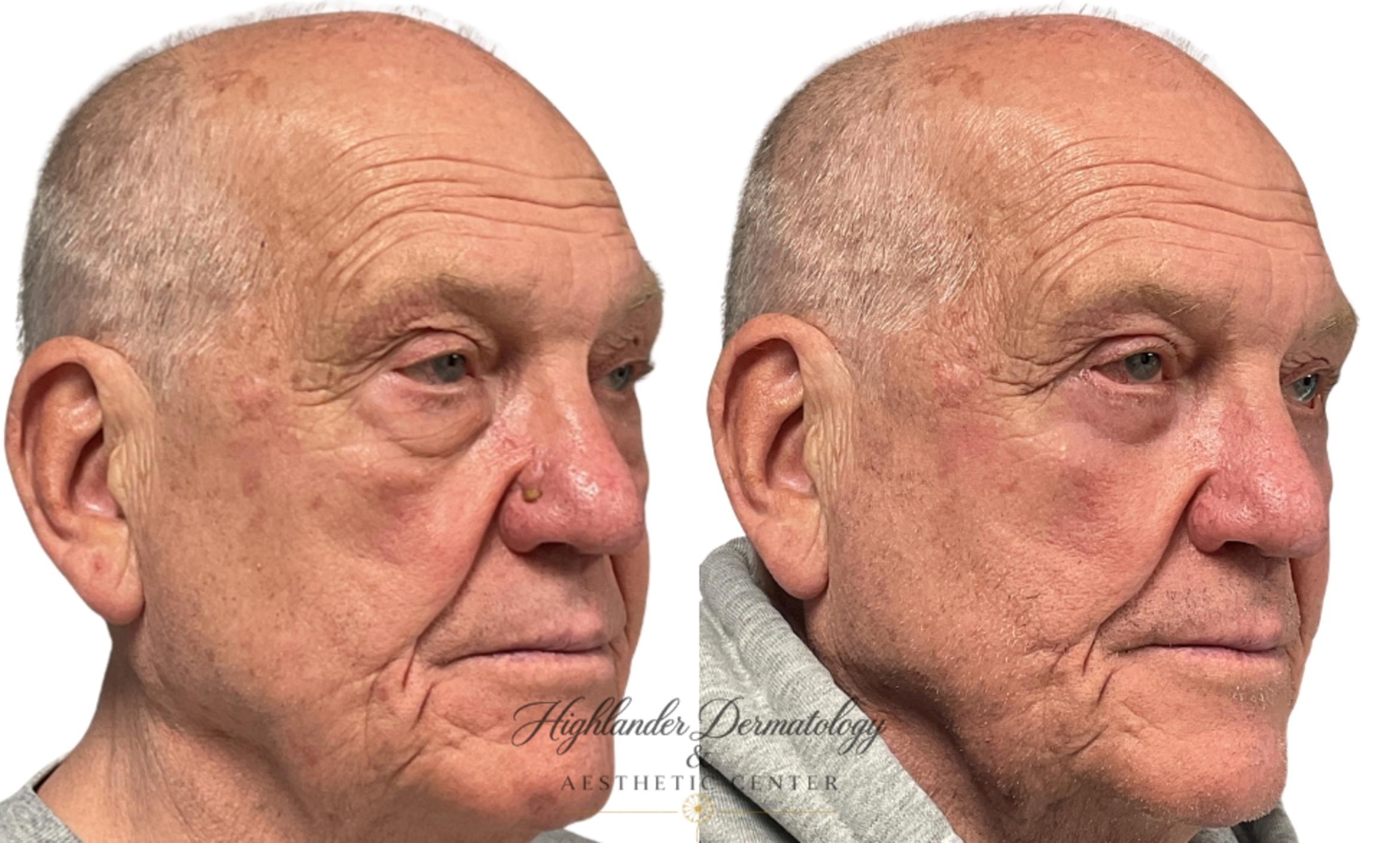 Before & After Eyelid Surgery (Blepharoplasty) Case 29 Right Oblique View in Brookfield, Franklin, Wisonsin