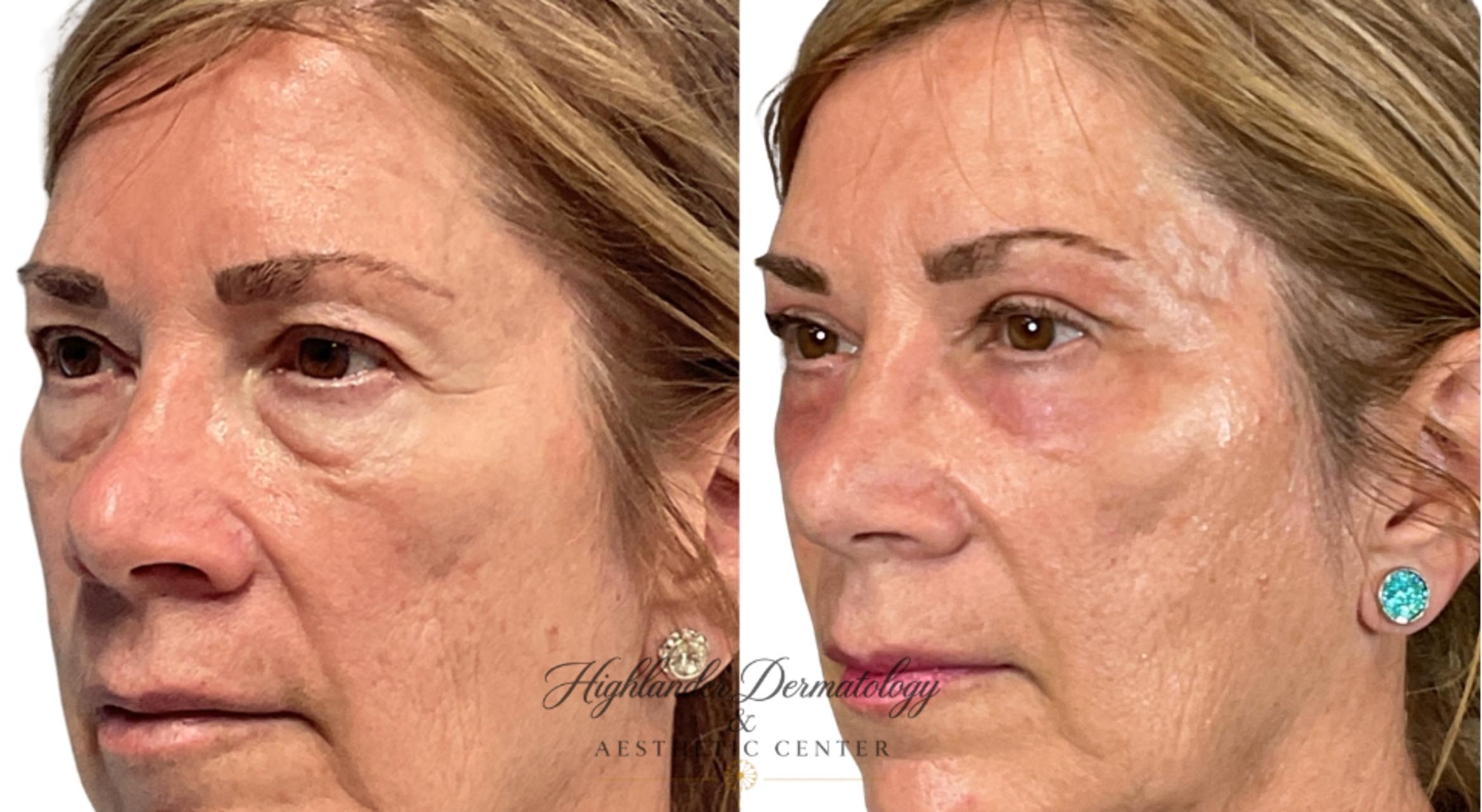 Before & After Eyelid Surgery (Blepharoplasty) Case 8 Left Oblique View in Brookfield, Franklin, Wisonsin