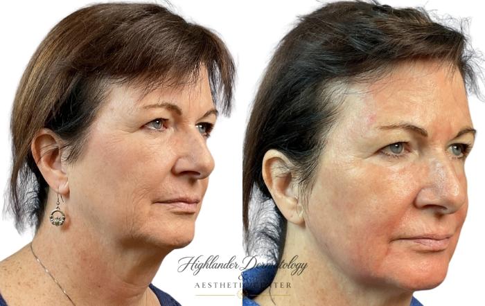 Before & After QuantumRF Face Case 21 Right Oblique View in Brookfield, Franklin, Wisonsin