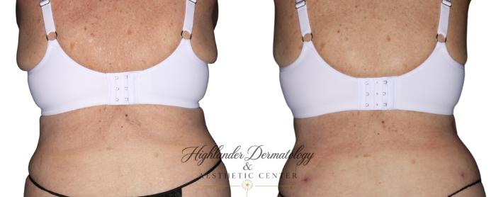 Before & After BodyTite Case 30 Back View in Brookfield, Franklin, Wisonsin
