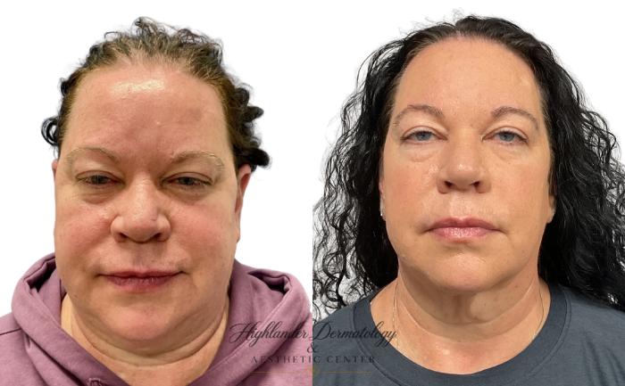 Before & After RFAL Face Case 12 Front View in Brookfield, Franklin, Wisonsin