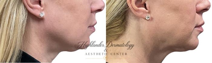 Before & After RFAL Face Case 14 Right Side View in Brookfield, Franklin, Wisonsin