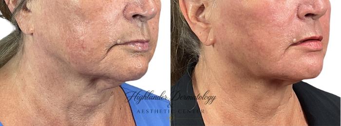 Before & After RFAL Face Case 17 Right Oblique View in Brookfield, Franklin, Wisonsin