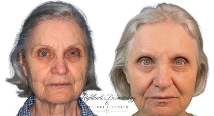 Before & After CO2 Laser Resurfacing Case 19 Front View in Brookfield, Franklin, Wisonsin