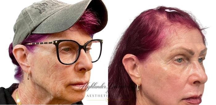 Before & After CO2 Laser Resurfacing Case 5 Right Oblique View in Brookfield, Franklin, Wisonsin