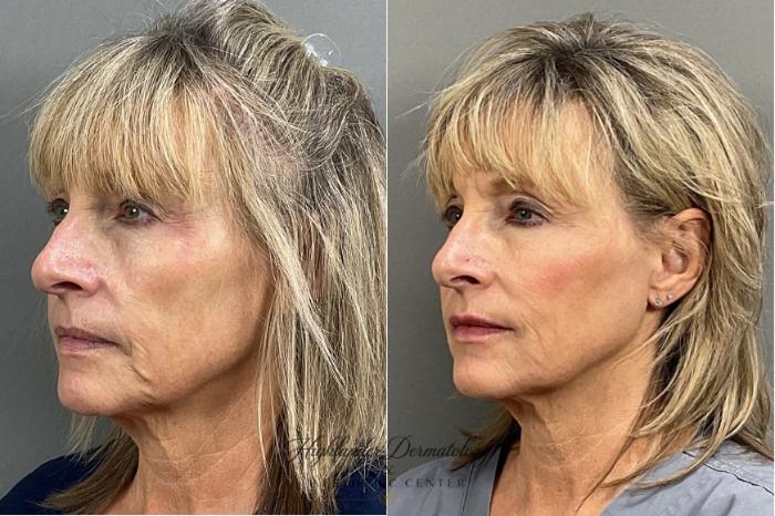 Before & After Dermal Fillers Case 7 Left Oblique View in Brookfield, Franklin, Wisonsin