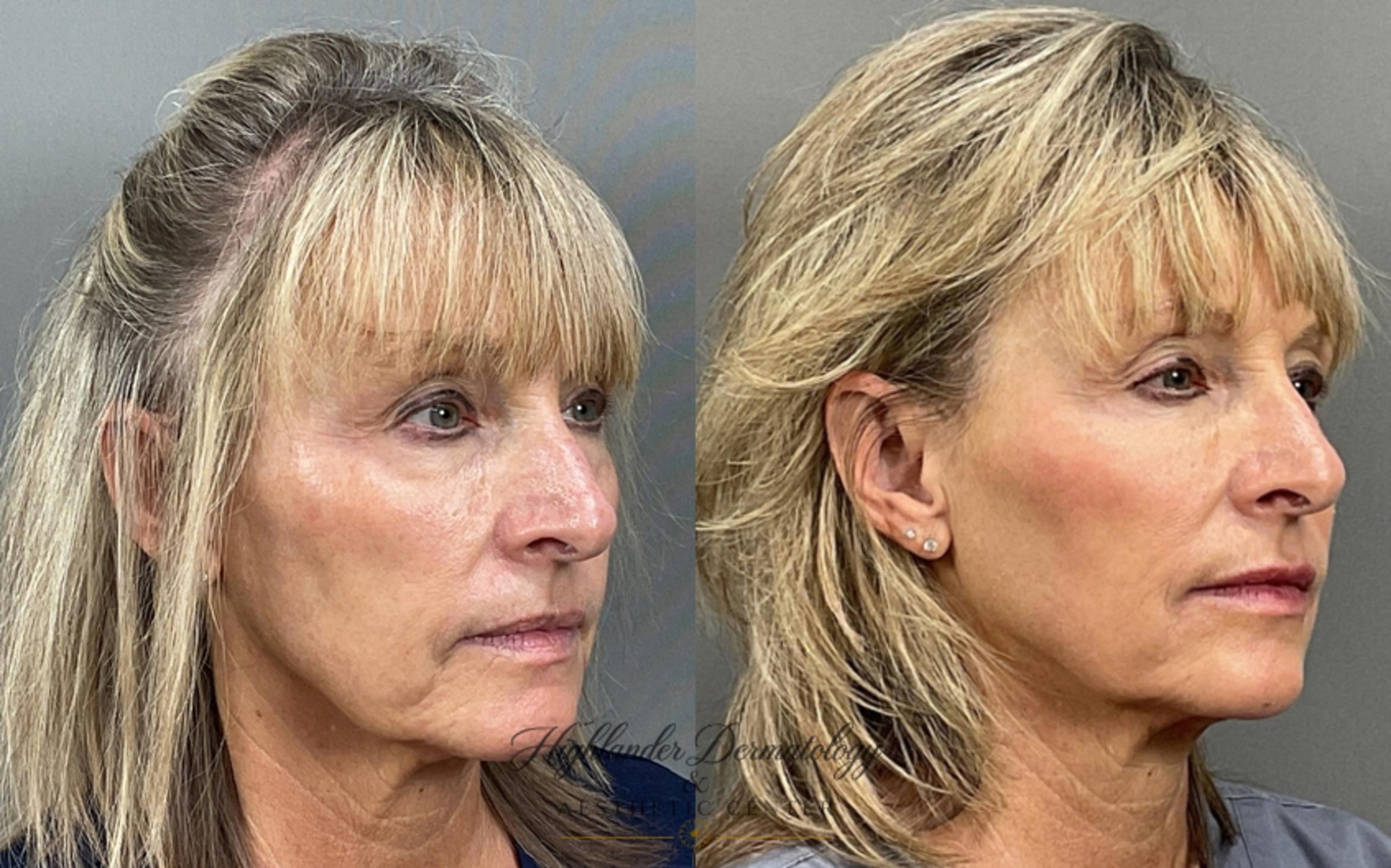 Before & After Dermal Fillers Case 7 Right Oblique View in Brookfield, Franklin, Wisonsin