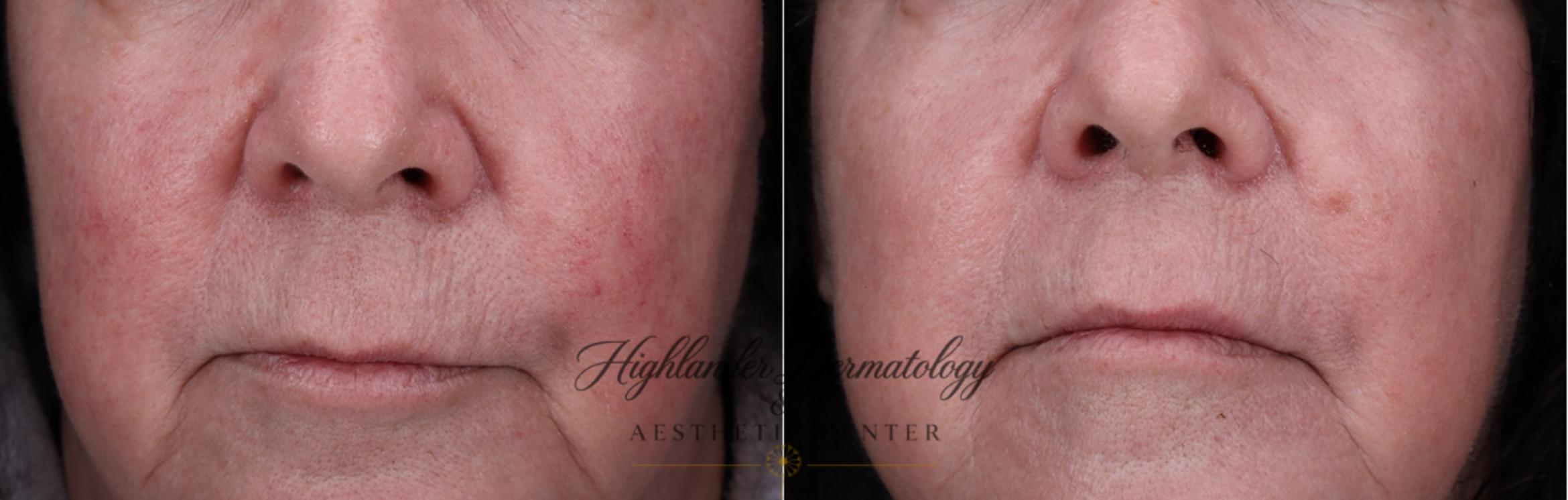 Before & After DermaV Case 28 Front View in Brookfield, Franklin, Wisonsin