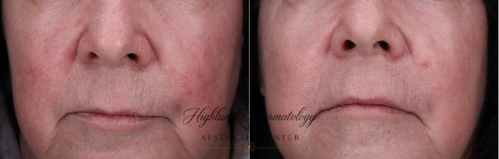 Before & After DermaV Case 28 Front View in Brookfield, Franklin, Wisonsin