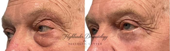 Before & After Eyelid Surgery (Blepharoplasty) Case 29 Close Up Left View in Brookfield, Franklin, Wisonsin