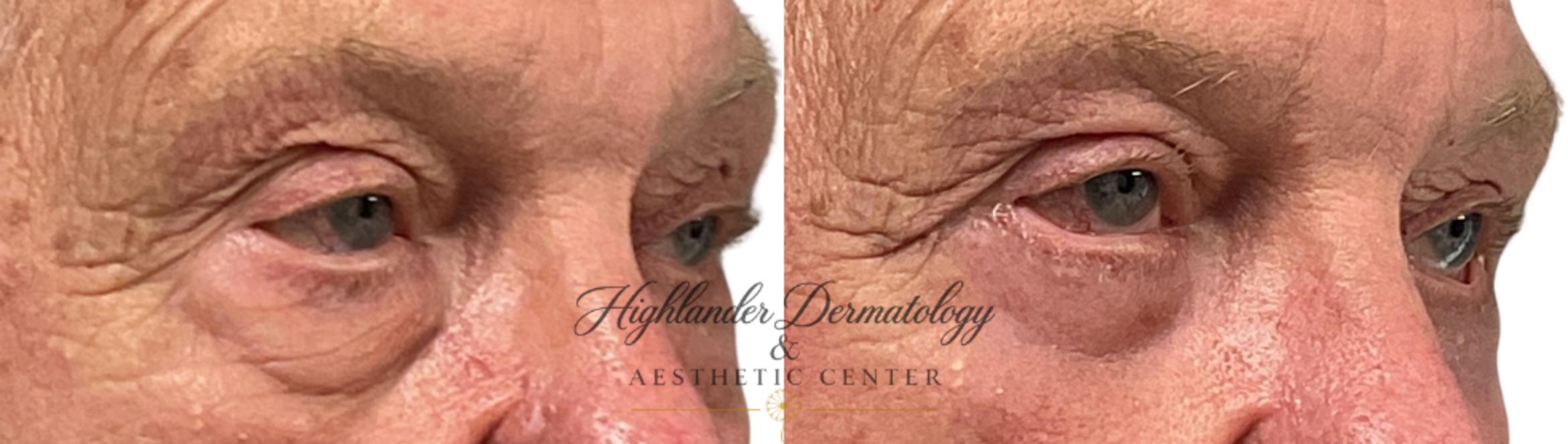 Before & After Eyelid Surgery (Blepharoplasty) Case 29 Close Up Right  View in Brookfield, Franklin, Wisonsin