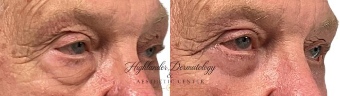 Before & After Eyelid Surgery (Blepharoplasty) Case 29 Close Up Right  View in Brookfield, Franklin, Wisonsin