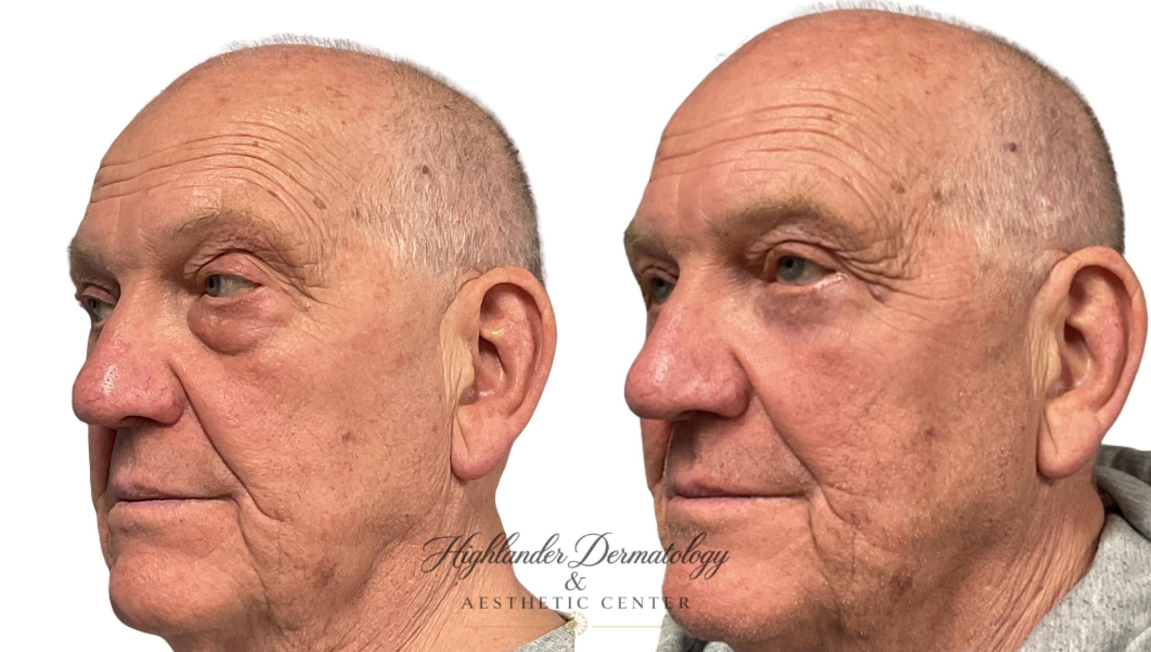 Before & After Eyelid Surgery (Blepharoplasty) Case 29 Left Side View in Brookfield, Franklin, Wisonsin