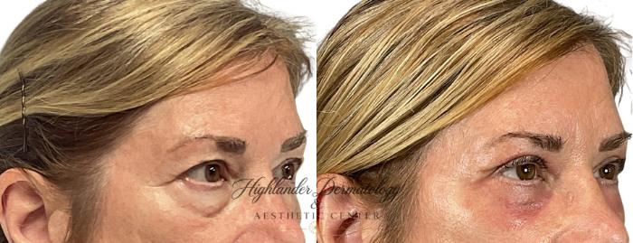 Before & After Eyelid Surgery (Blepharoplasty) Case 8 Right Oblique View in Brookfield, Franklin, Wisonsin
