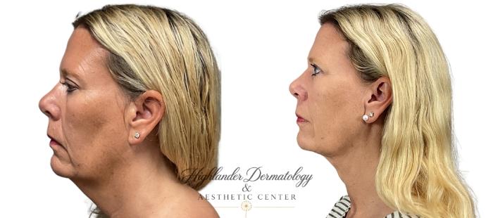Before & After FaceTite Case 3 Left Side View in Brookfield, Franklin, Wisonsin