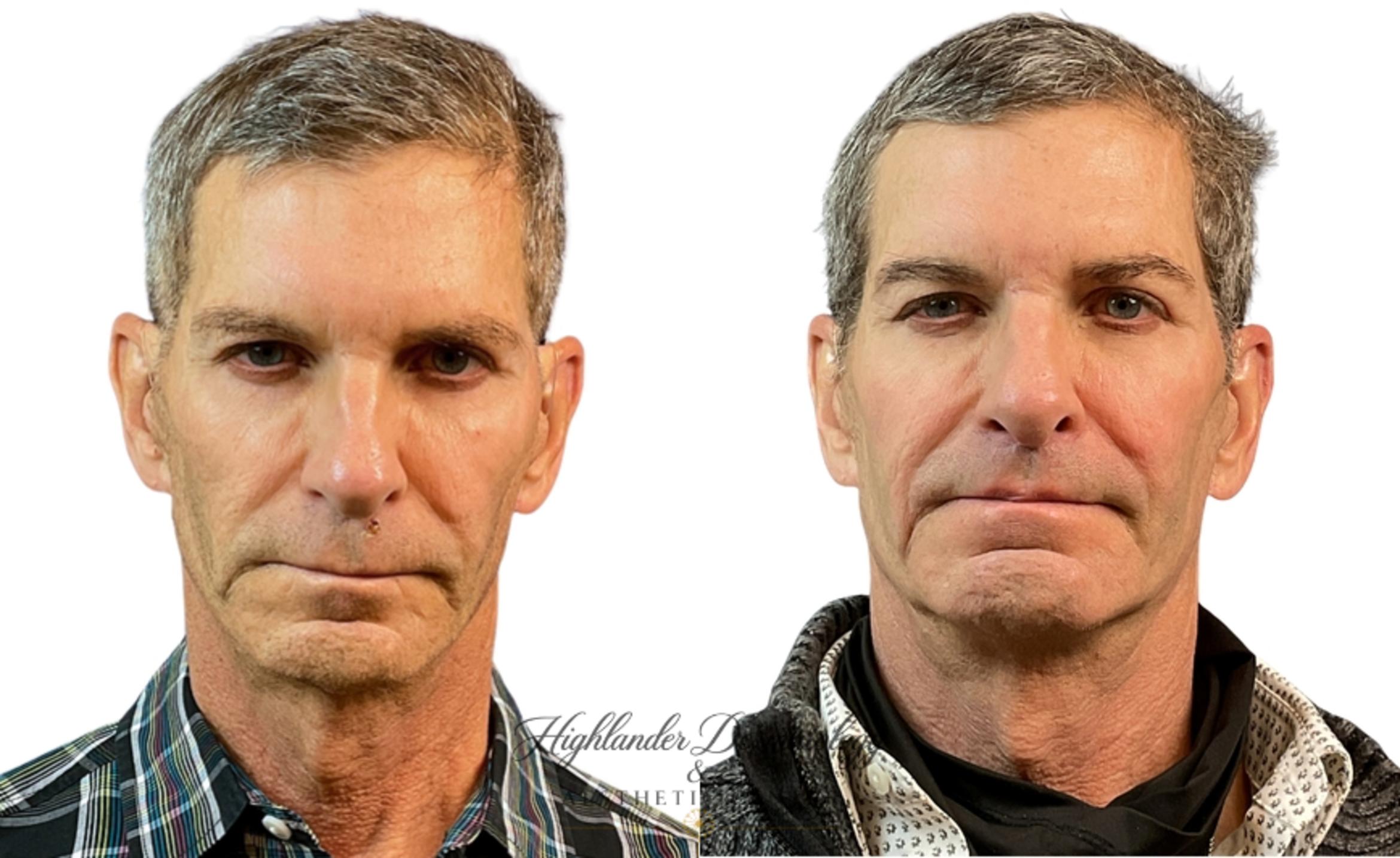 Before & After Facial Fat Transfer Case 2 Front View in Brookfield, Franklin, Wisonsin