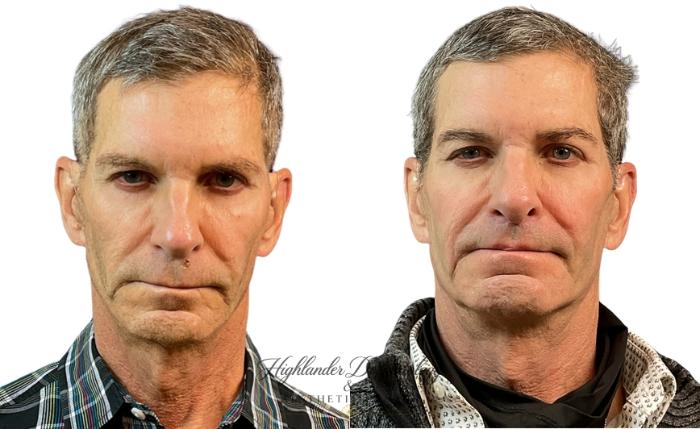 Before & After Facial Fat Transfer Case 2 Front View in Brookfield, Franklin, Wisonsin