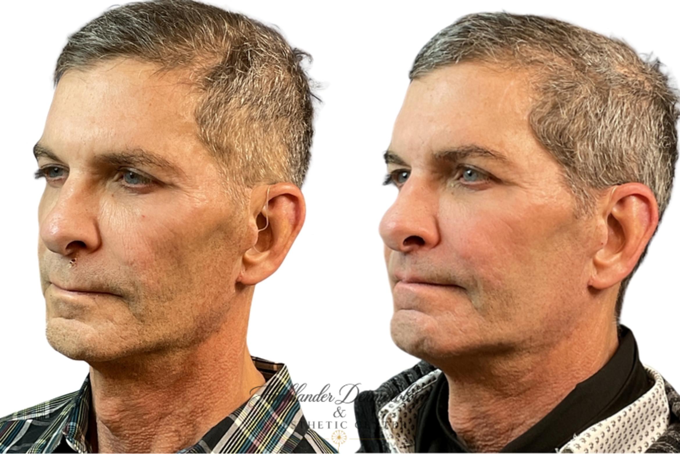 Before & After Facial Fat Transfer Case 2 Right Side View in Brookfield, Franklin, Wisonsin
