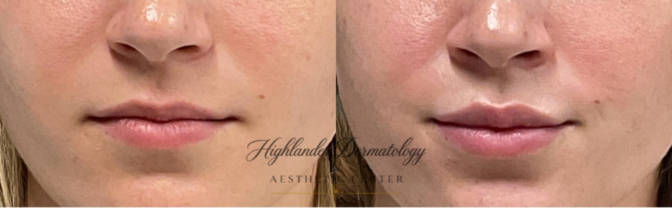 Before & After Lip Filler Case 16 Front View in Brookfield, Franklin, Wisonsin