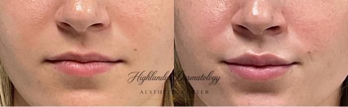 Before & After Lip Filler Case 16 Front View in Brookfield, Franklin, Wisonsin