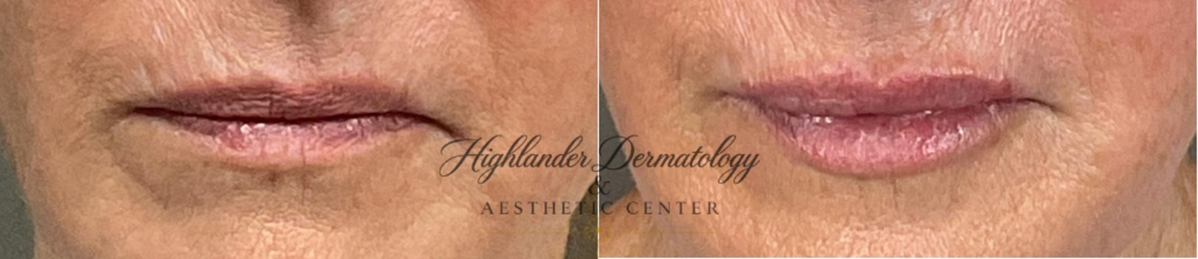 Before & After Lip Filler Case 27 Front View in Brookfield, Franklin, Wisonsin