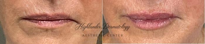 Before & After Lip Filler Case 27 Front View in Brookfield, Franklin, Wisonsin