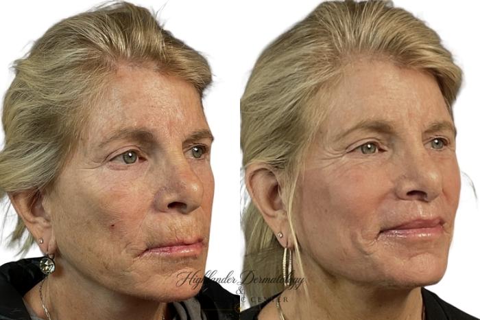 Before & After Lip Lift (Bullhorn) Case 1 Right Oblique View in Brookfield, Franklin, Wisonsin