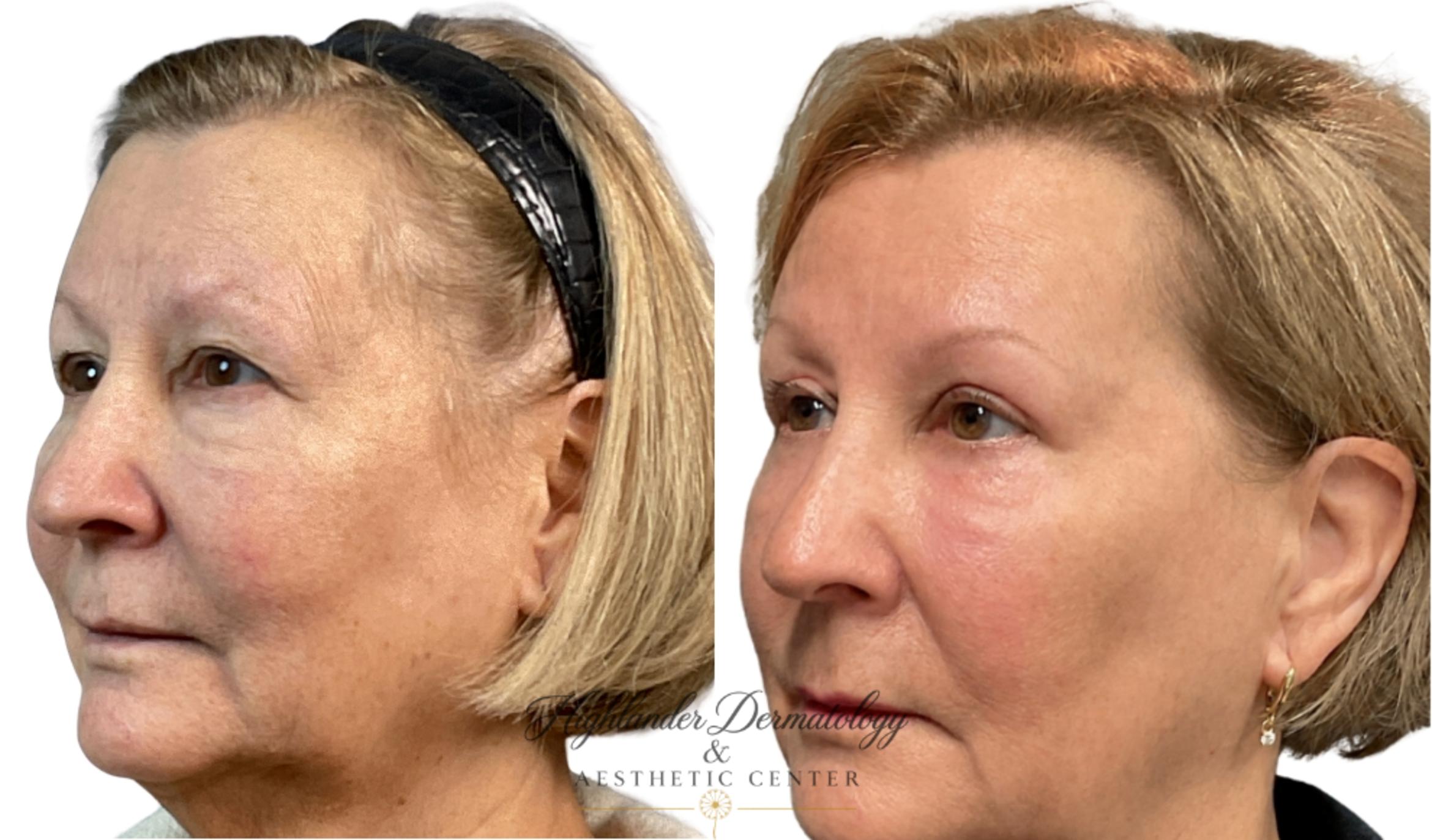 Before & After Non-Surgical Brow Lift Case 9 Left Oblique View in Brookfield, Franklin, Wisonsin