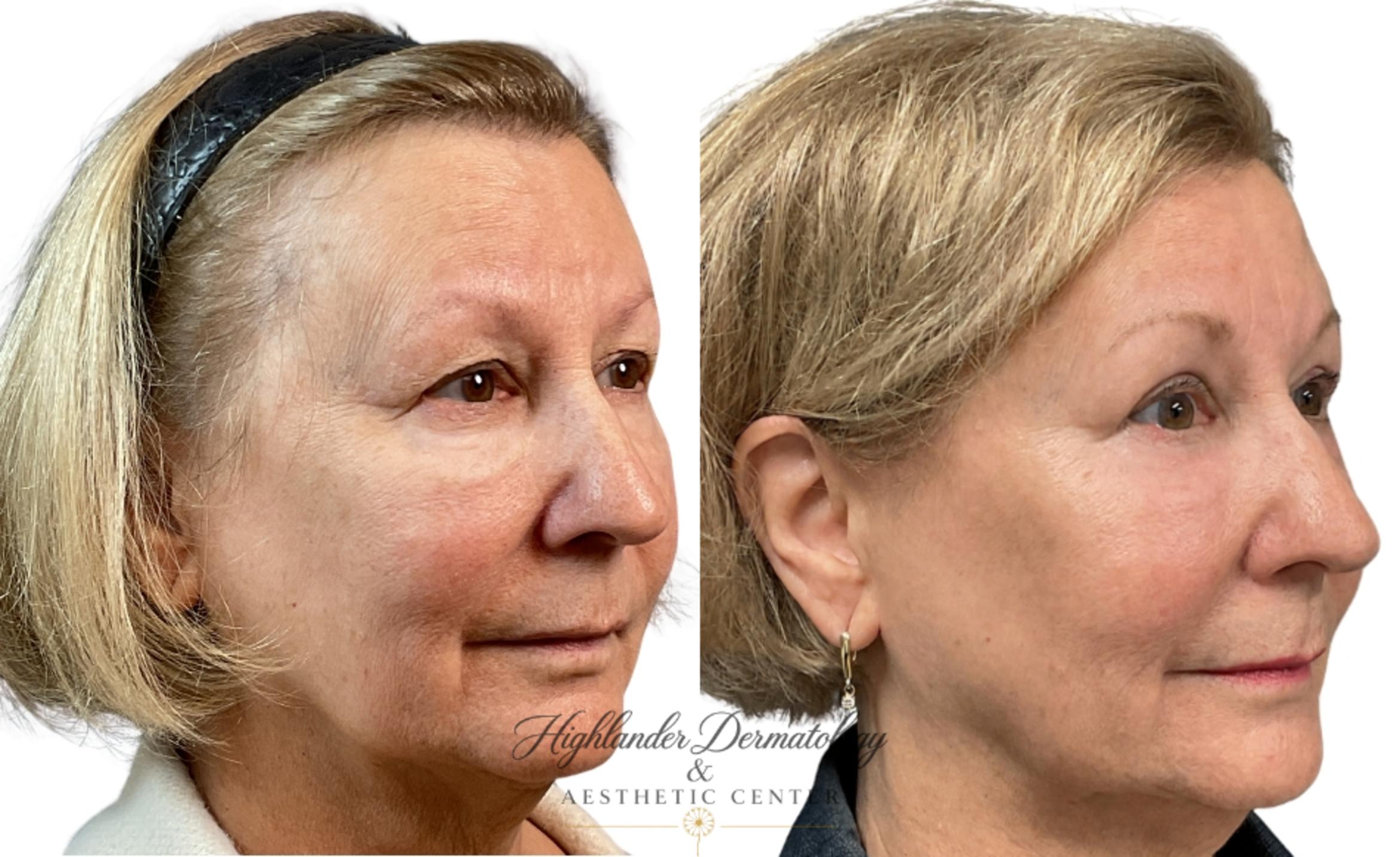 Before & After Non-Surgical Brow Lift Case 9 Right Oblique View in Brookfield, Franklin, Wisonsin