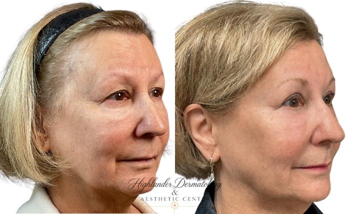 Before & After Non-Surgical Brow Lift Case 9 Right Oblique View in Brookfield, Franklin, Wisonsin