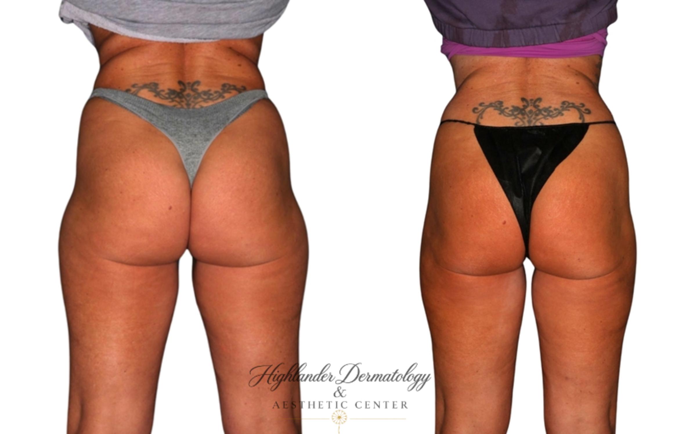 Before & After BodyTite Case 10 Back View in Brookfield, Franklin, Wisonsin
