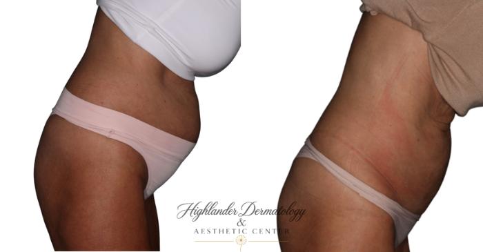 Before & After BodyTite Case 11 Right Side Bend Pose  View in Brookfield, Franklin, Wisonsin