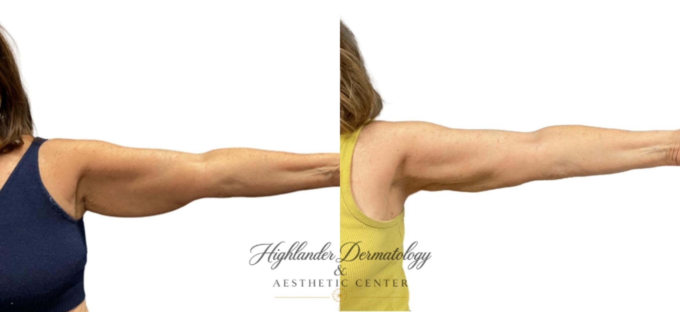 Before & After BodyTite Case 13 Front View in Brookfield, Franklin, Wisonsin