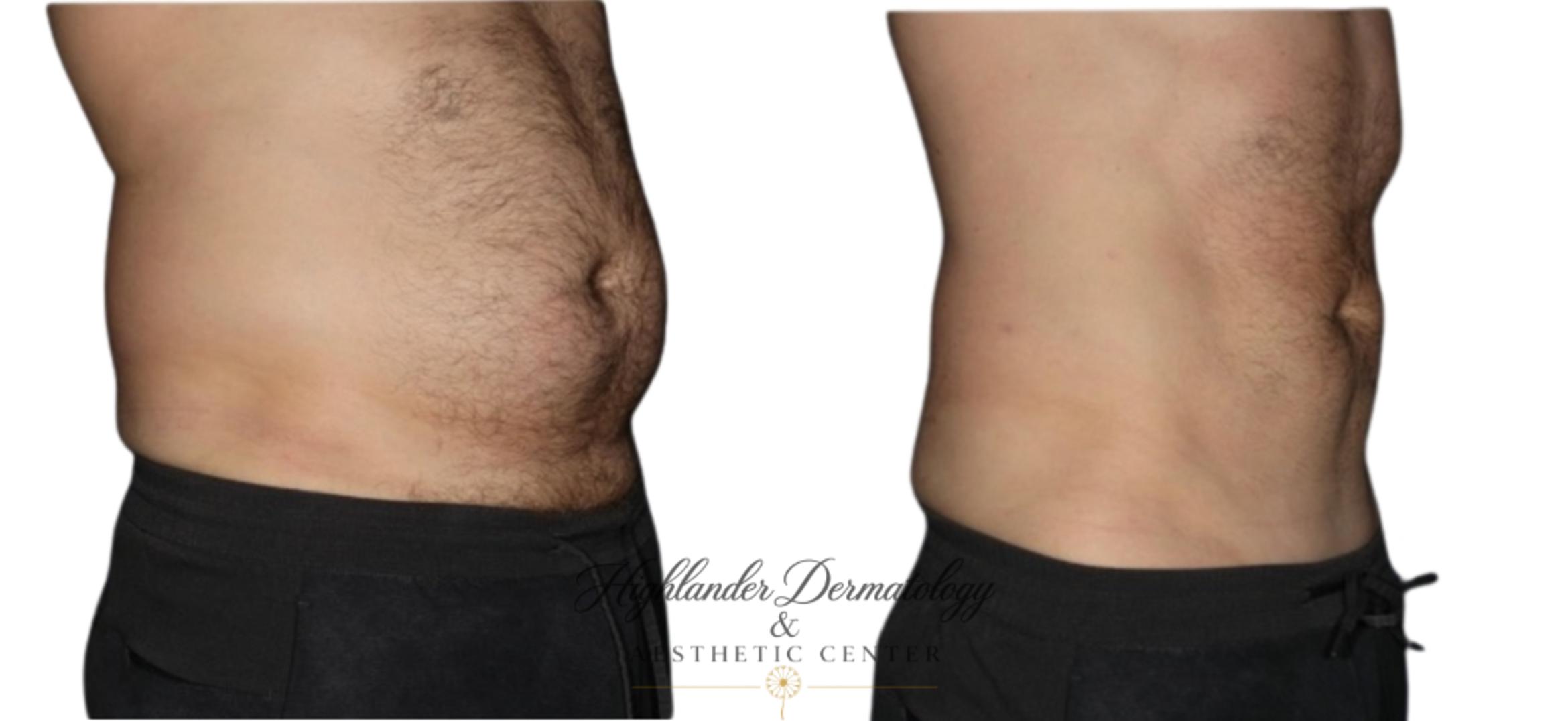 Before & After BodyTite Case 6 Right Oblique View in Brookfield, Franklin, Wisonsin