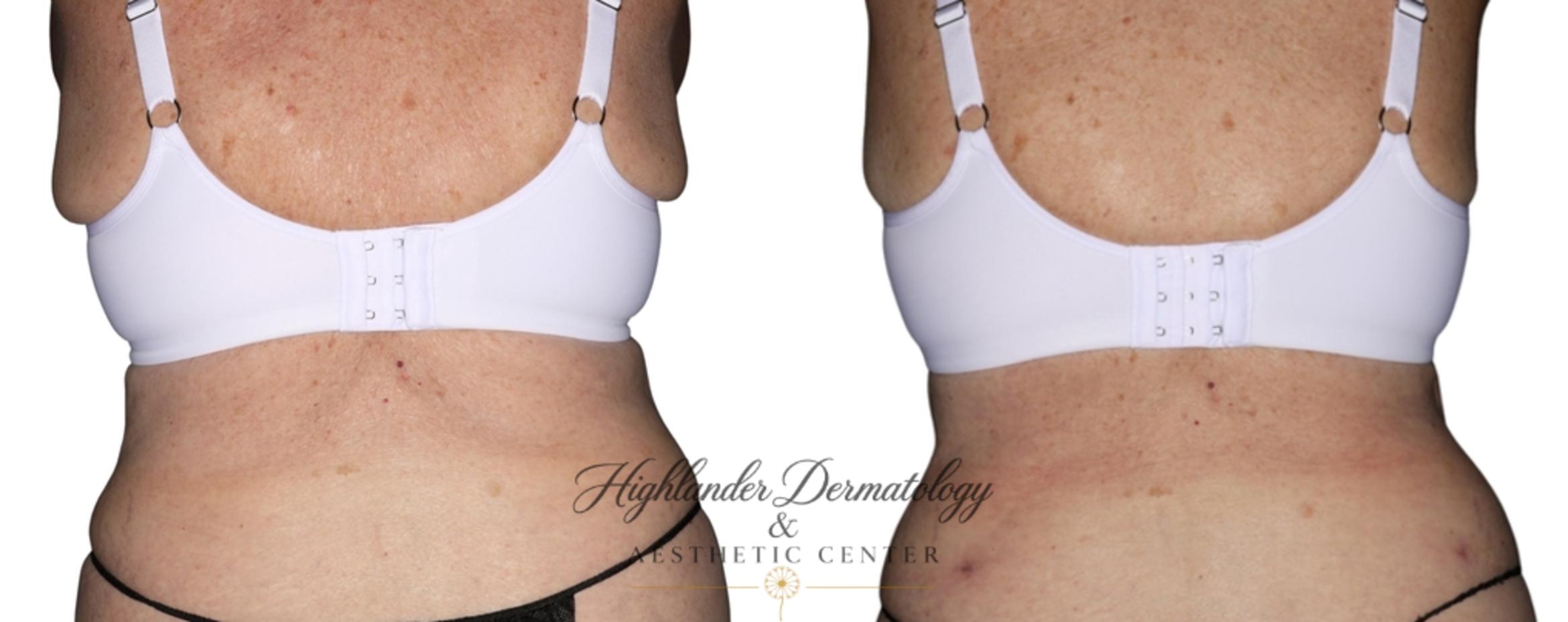 Before & After BodyTite Case 30 Back View in Brookfield, Franklin, Wisonsin