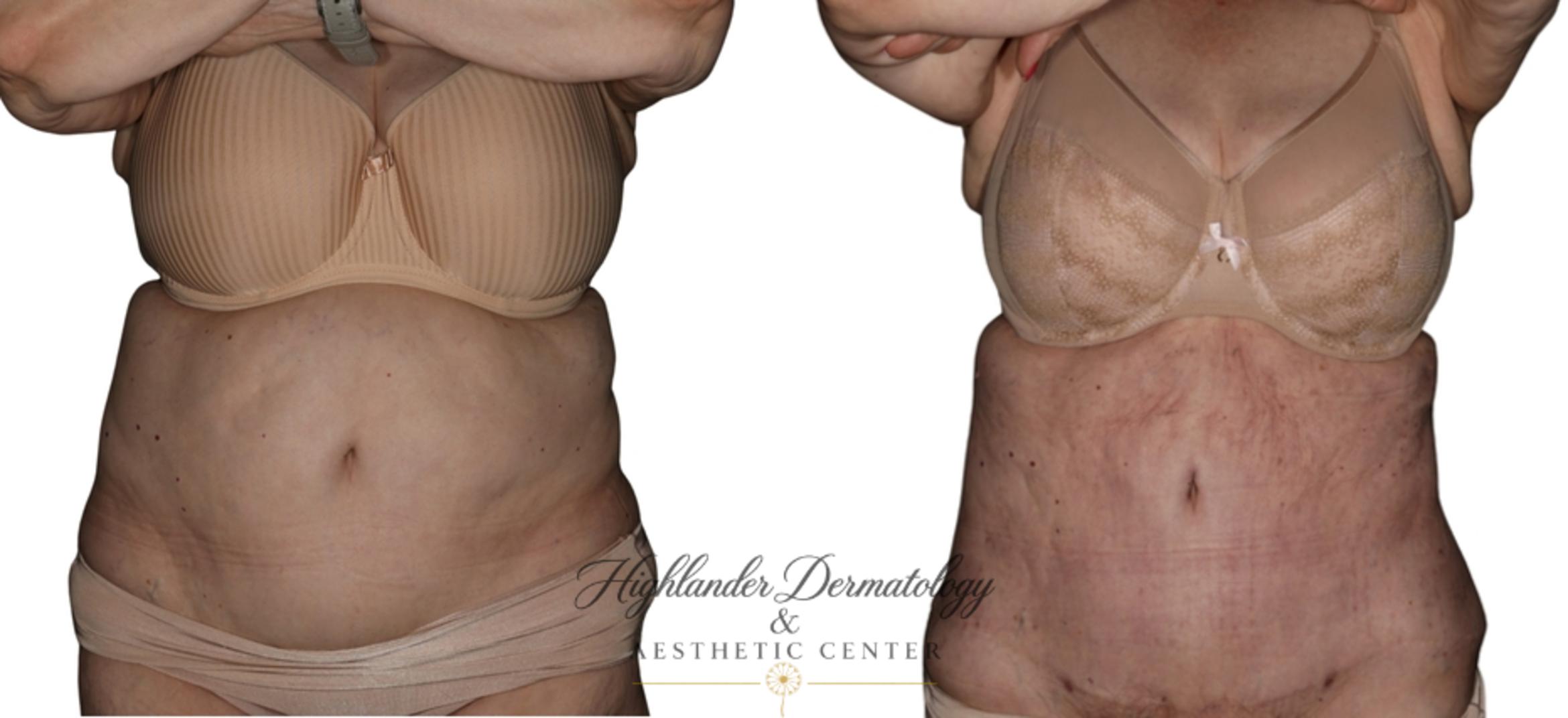 Before & After BodyTite Case 33 Front View in Brookfield, Franklin, Wisonsin