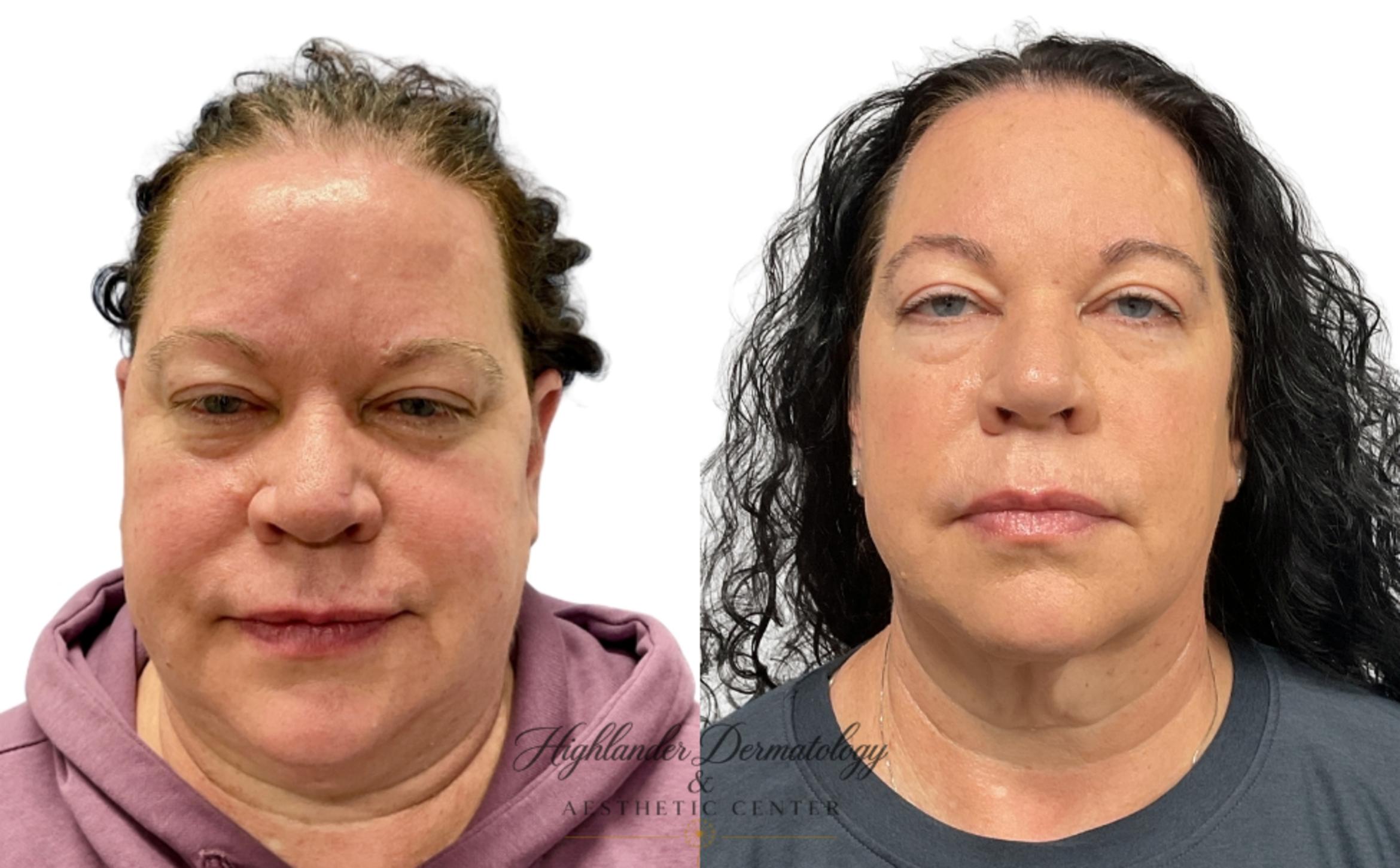 Before & After RFAL Face Case 12 Front View in Brookfield, Franklin, Wisonsin