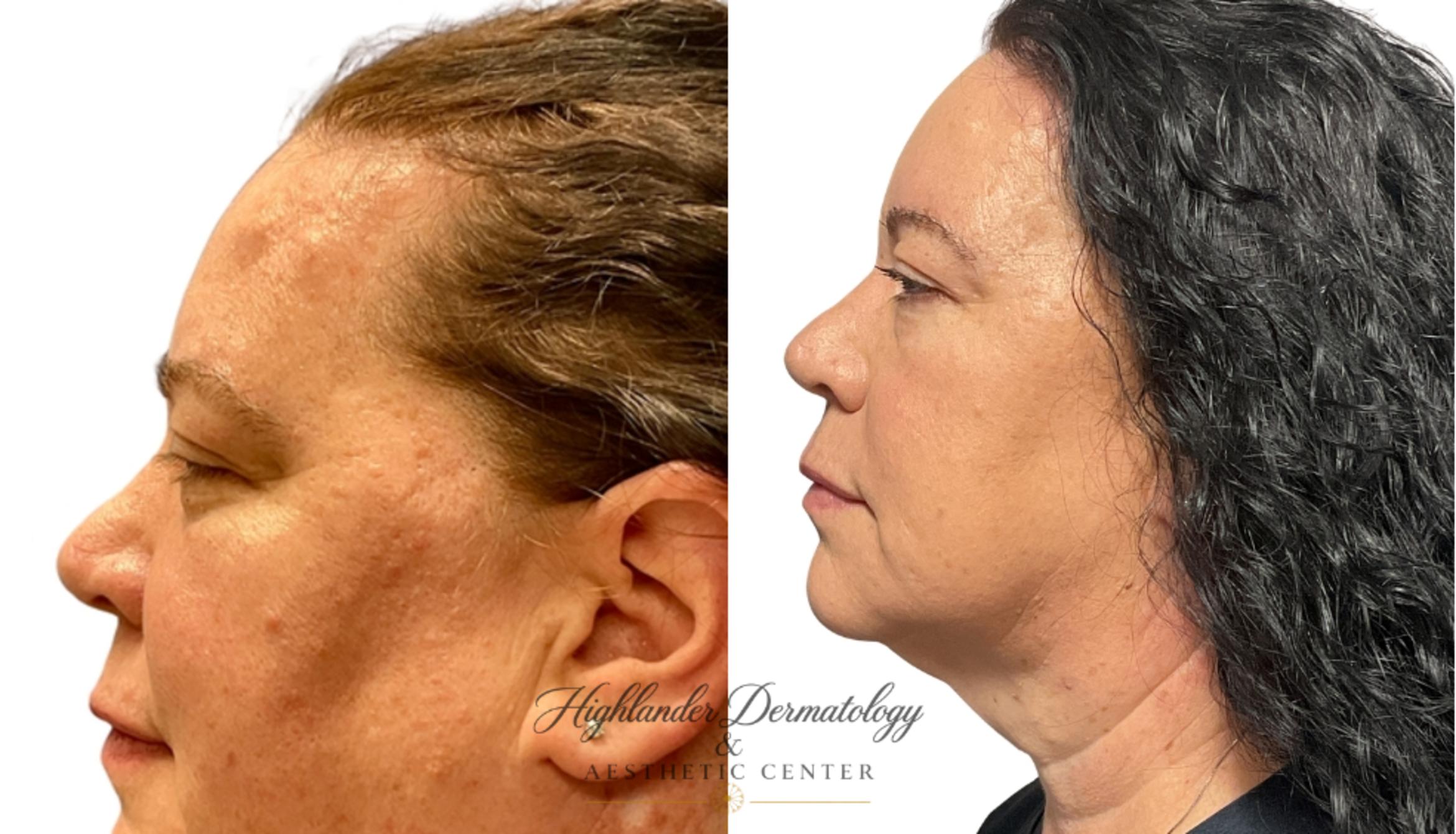 Before & After RFAL Face Case 12 Left Side View in Brookfield, Franklin, Wisonsin