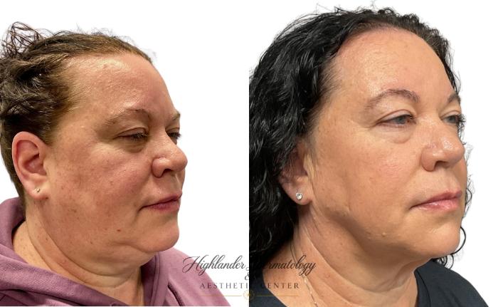 Before & After RFAL Face Case 12 Right Oblique View in Brookfield, Franklin, Wisonsin