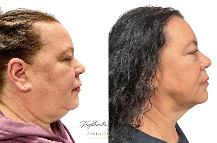 Before & After RFAL Face Case 12 Right Side View in Brookfield, Franklin, Wisonsin